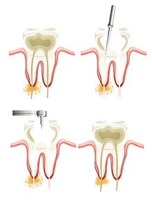 Illustration of a root canal procedure