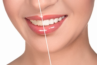 Teeth whitening can brighten your smile