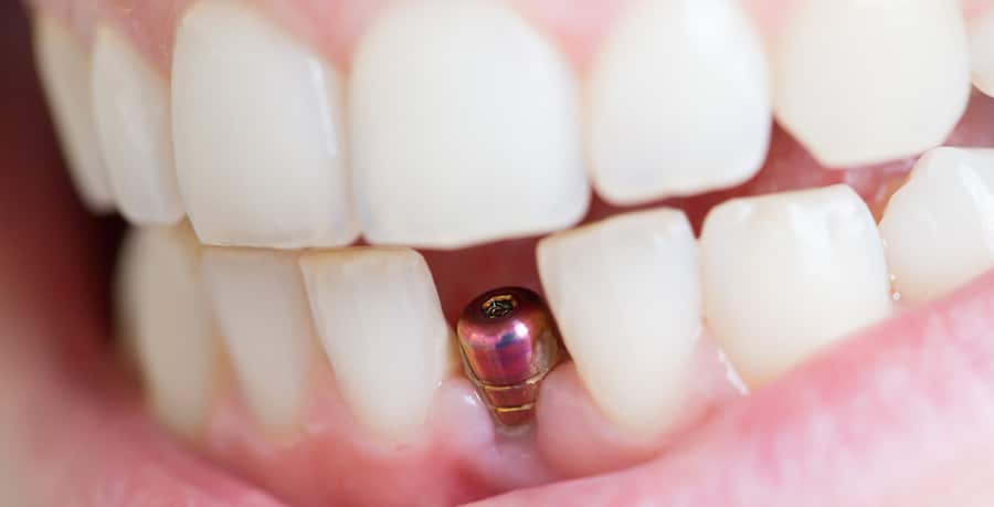 single tooth implant