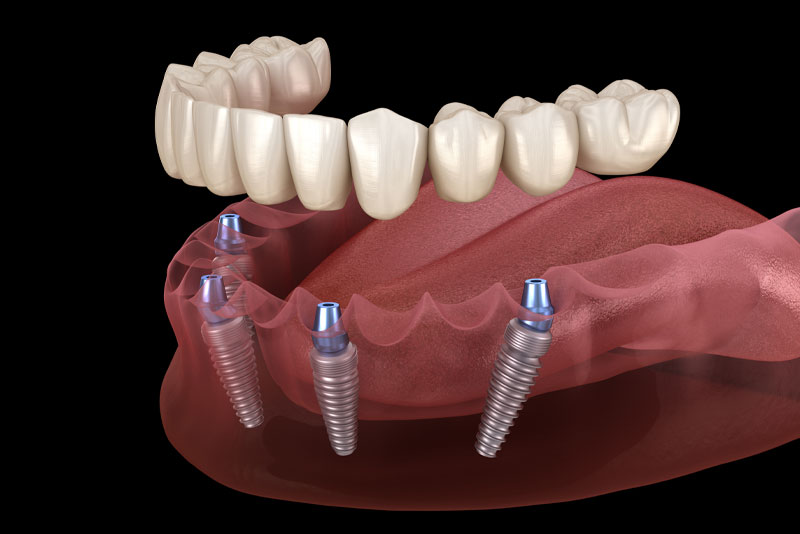 All On 4 Dental Implant Model