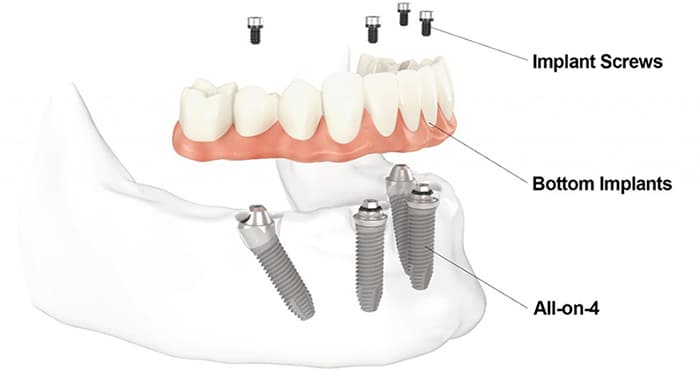 How All On 4 Dental Implants Work