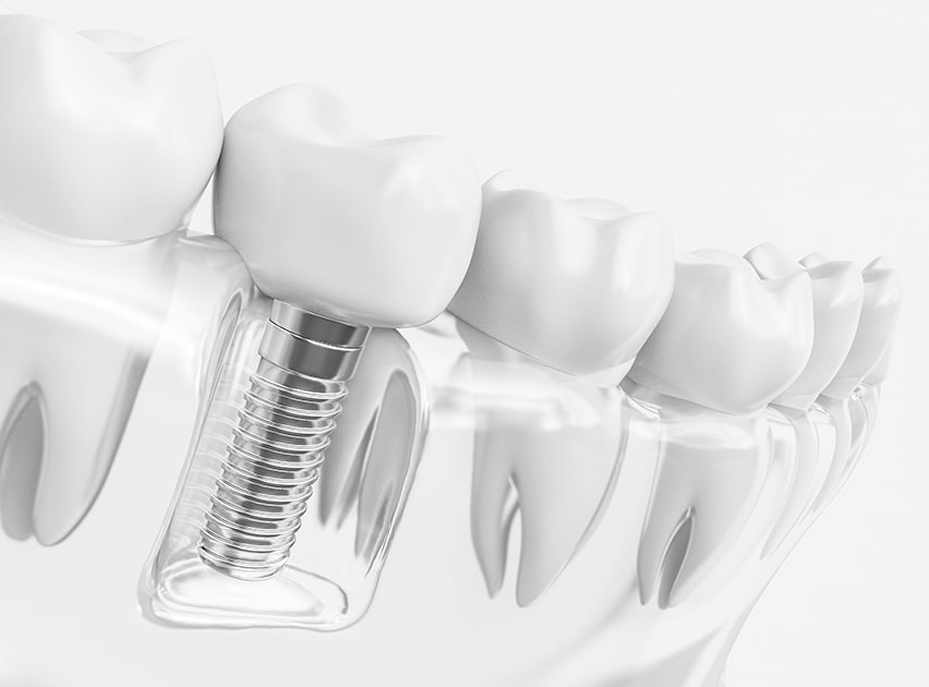 A diagram of a human dental implant. What do the advances in technology mean for Dental Implants?