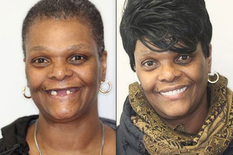 implant supported dentures patient before and after