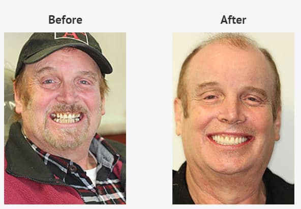 An All-on-4 Implants patient of Dr. George Sepiashvili and Dr. Wanda Mejia, Westchester County Cosemtic Dentists. One of the biggest mistakes you can make with All-on-4 dental implants is not choosing an experienced dental implant dentist.