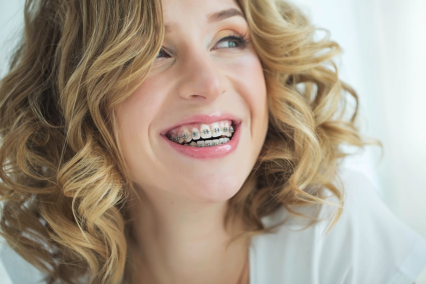 Woman smiles with braces on