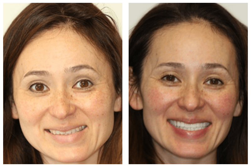 case 1 smile makeover before and after