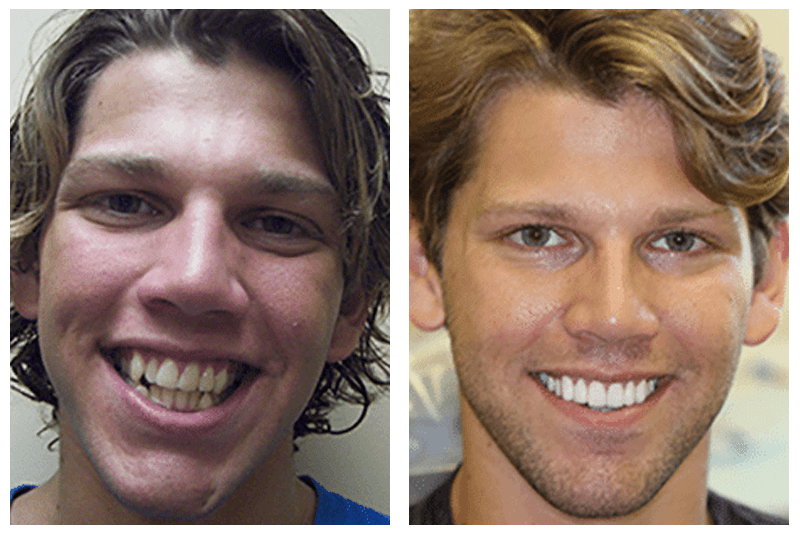case 2 dental veneers before and after