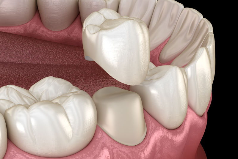 dental crown model