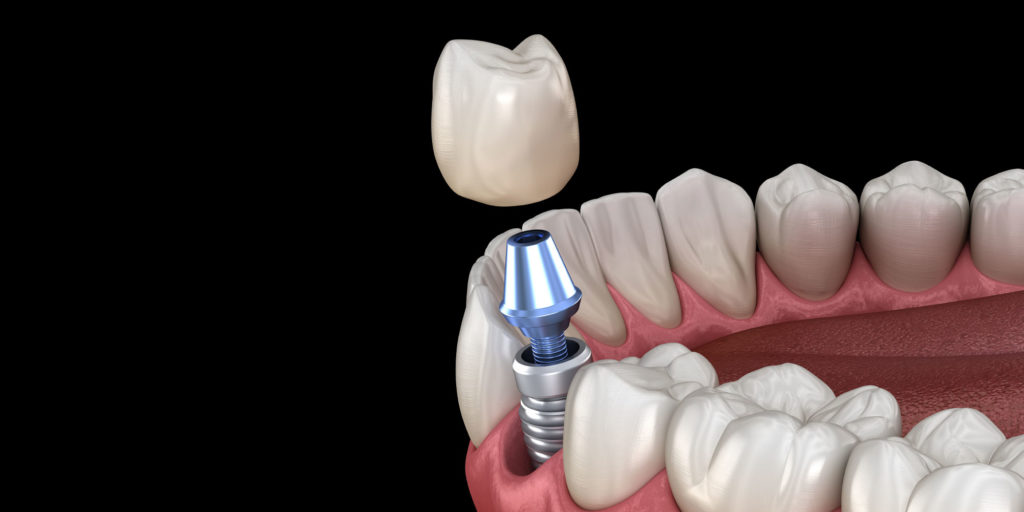 dental implant model