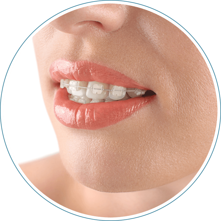 dental patient wearing fastbraces