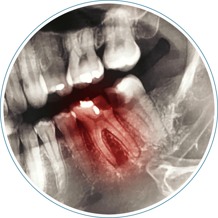 root canal xray graphic