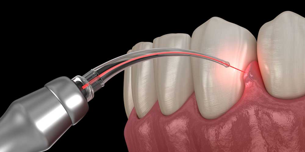 Laser Gum Disease Treatment