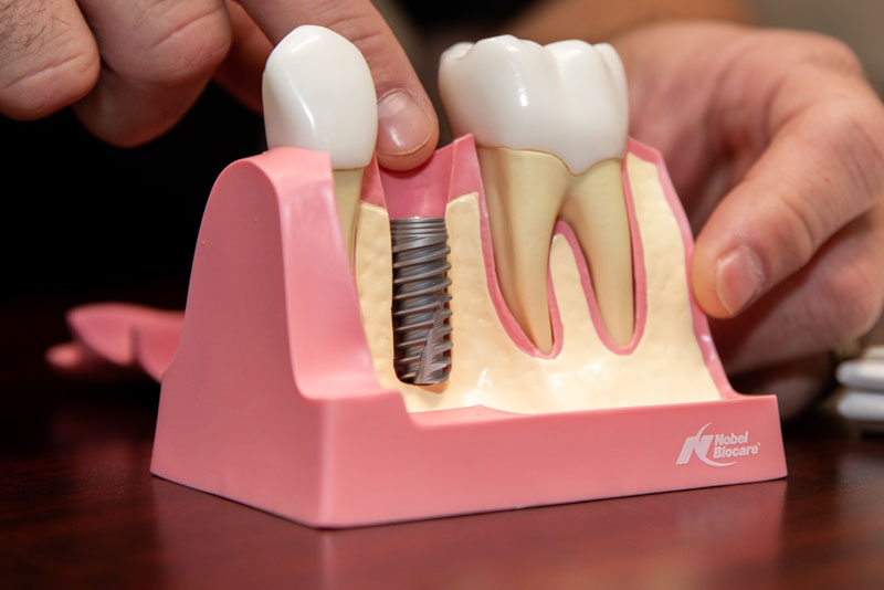 Dental Implant in your Bone, Model