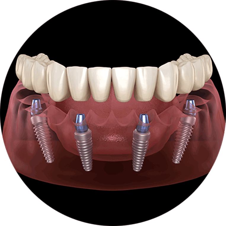 a model of full arch dental implants