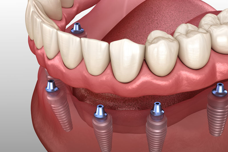 Implant Supported Dentures Graphic