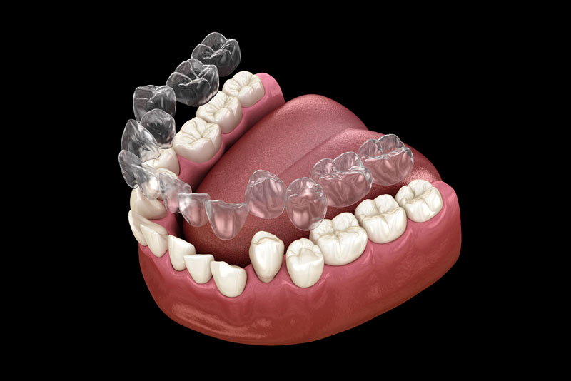 Clear Aligner Graphic