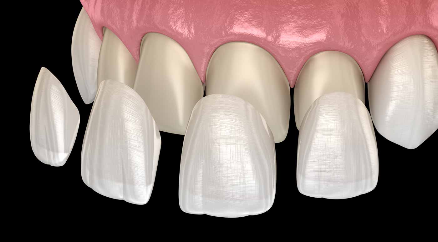 a diagram of dental veneers being placed