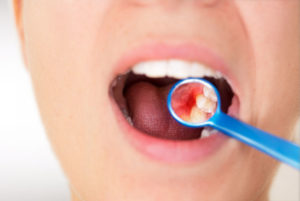 Dental Patient Needing A Periodontal Treatment