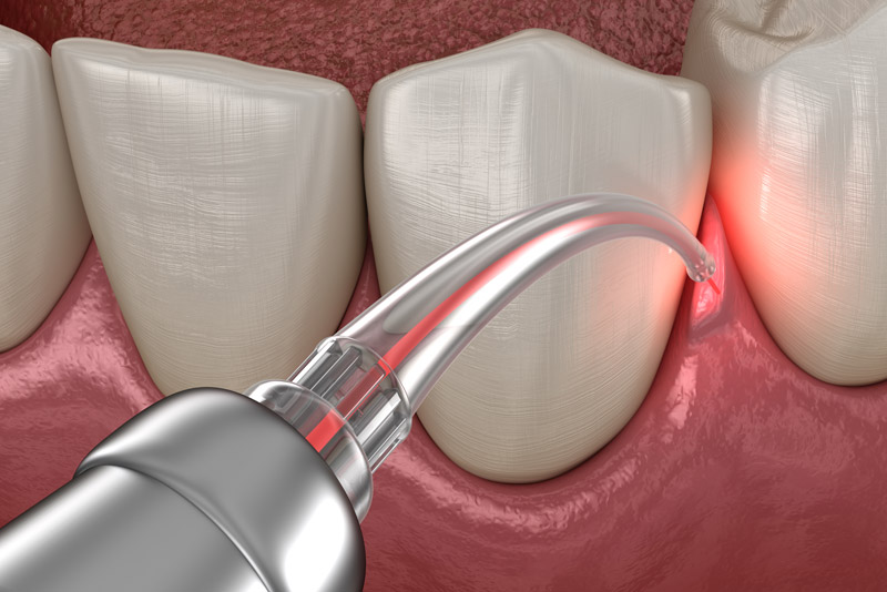 Gum Disease Laser Treatment Close Up