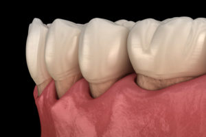 Gum Recession Graphic Close Up