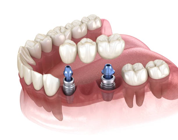 Dental Implant Dentist in Westchester NY