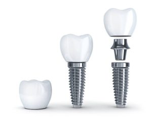 dental implant dentist in westchester ny