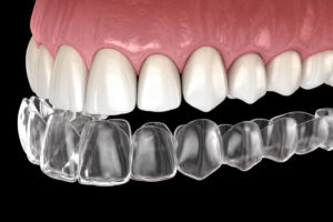 invisalign being placed on model of teeth for cosmetic dentistry