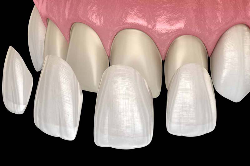 a diagram of porcelain veneers being placed