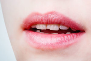 Chipped Front Teeth In Mouth, Ideal Candidate For A Smile Makeover