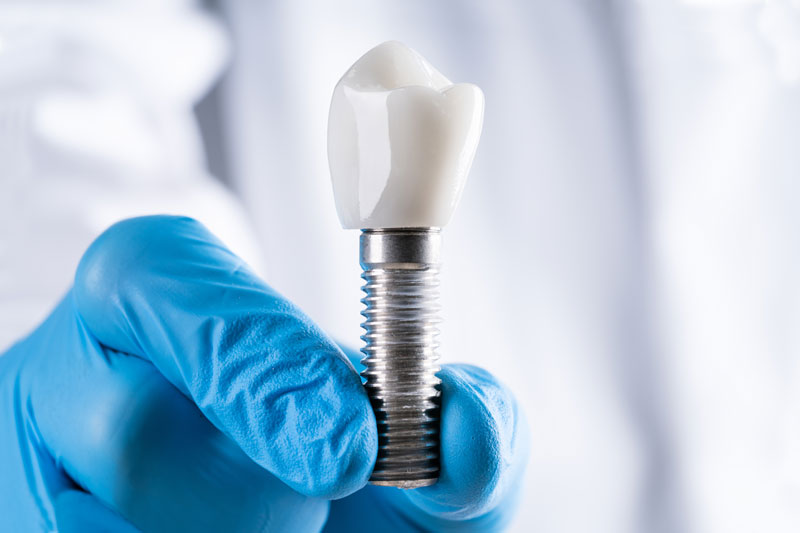 a doctor holding a single dental implant, one of the many dental implant options patients can choose from to restore their smile.