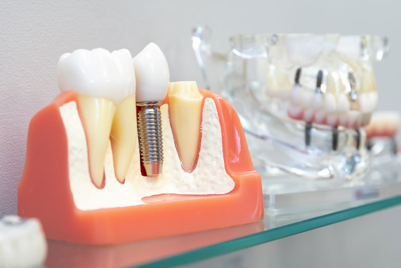 a picture of a dental implant model that shows how dental implants can replace missing teeth.