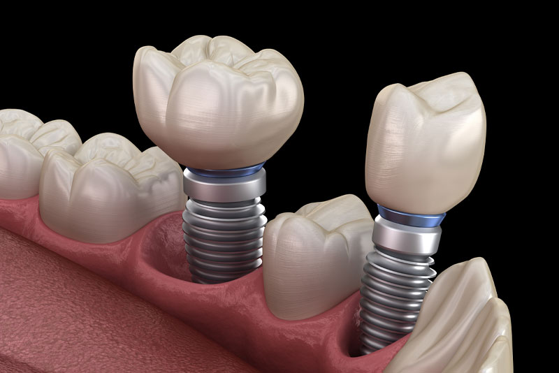 Model Of 2 Dental Implants In A Mouth