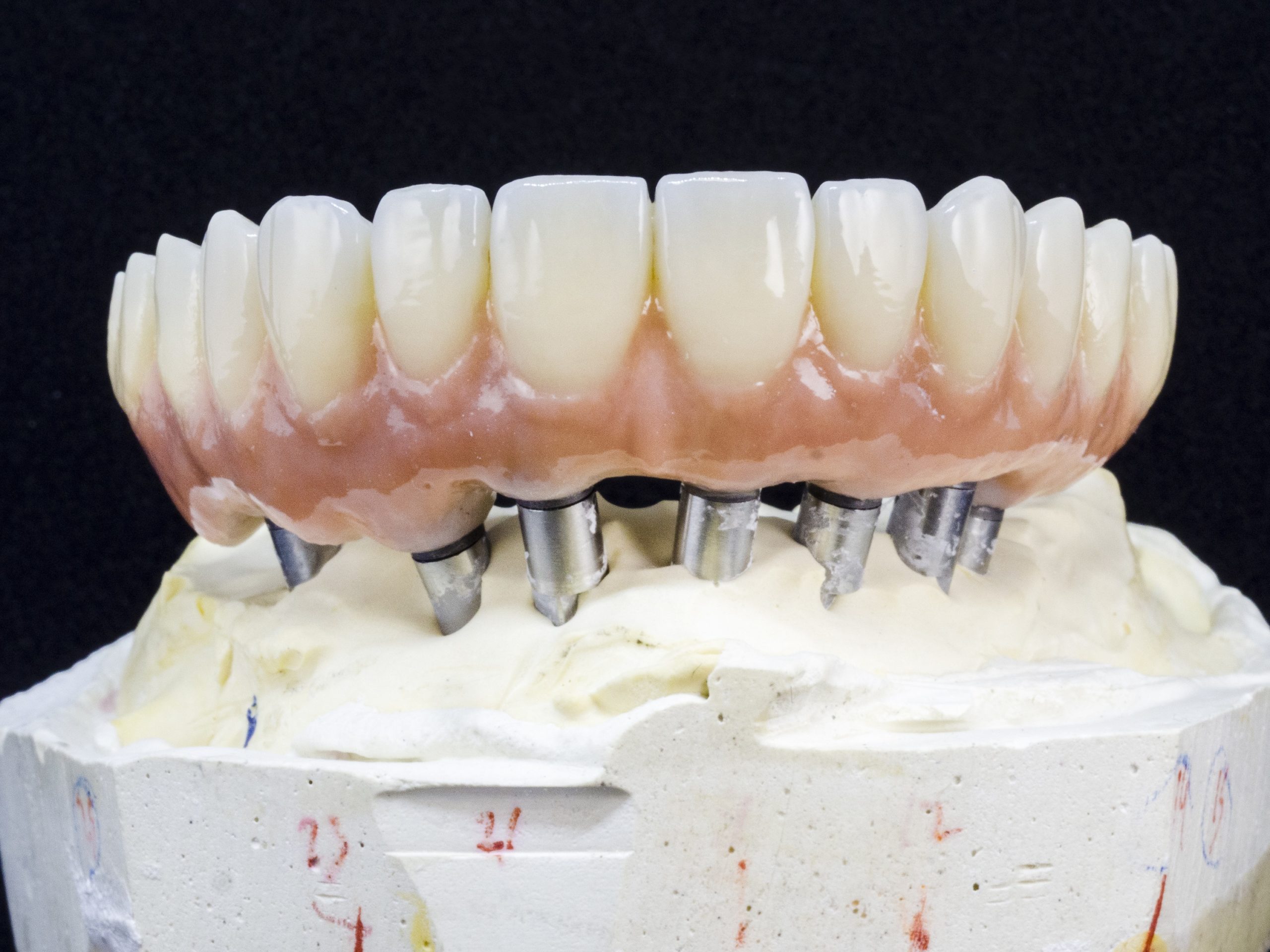 an implant supported denture