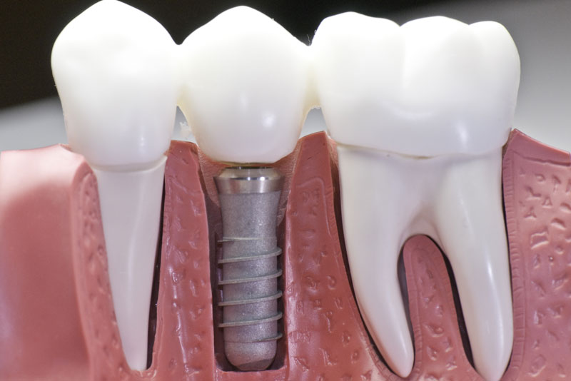 a digital model of a jaw cutaway showing a dental implant post and crown.