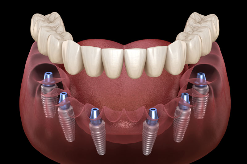 a full mouth dental implant model that shows how people can replace a full arch of missing teeth with full mouth dental implants by using six dental implants to support a full arch prosthesis.