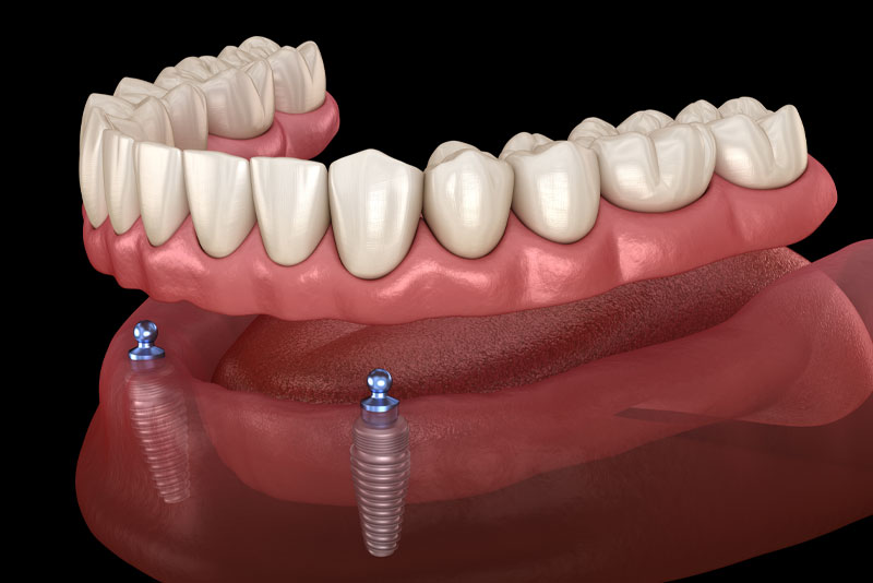 a denture implant model that shows how denture implants can benefit patients smiles by using two or more dental implants to stabilize a denture.