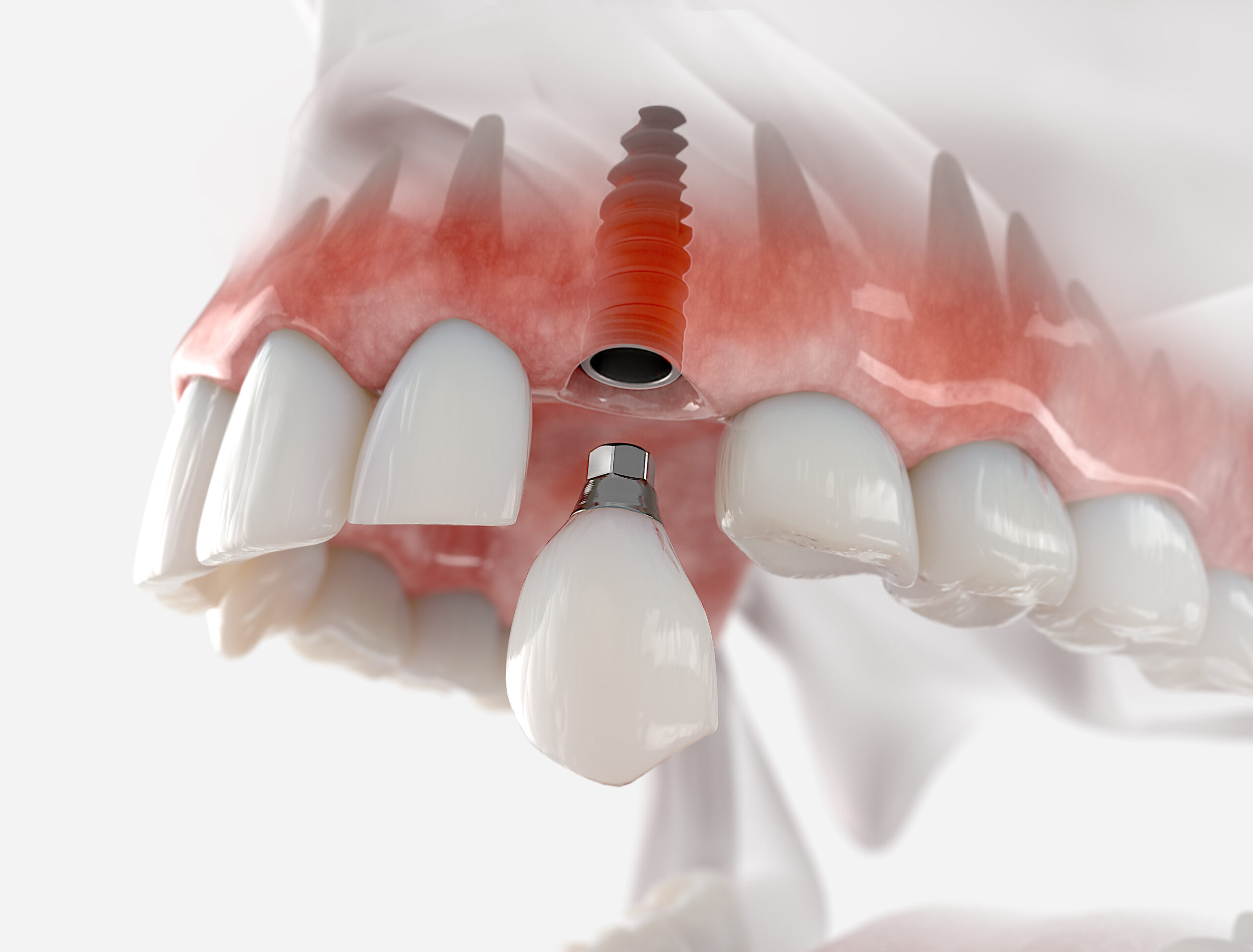 an image of tooth implants.