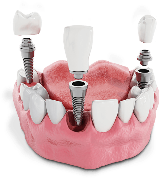 Multiple Dental Implants Above Gumline Graphic