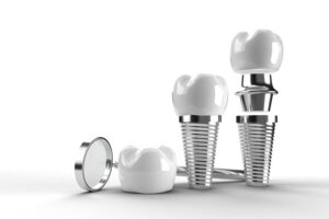 a tooth implant thats showing the layers of the implant with a mirror on the left