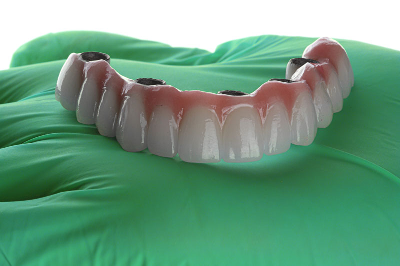 a full arch of teeth with 4 holes for implants to be placed into the mouth