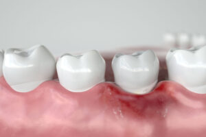 periodontitis in the gums highlighted by its redness