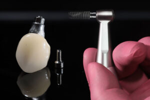 a single dental implant with a dentist holding up a tool that can be used to place the implant