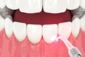 LANAP Laser Gum Surgery