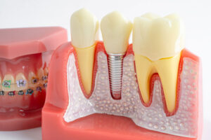 Dental implant, artificial tooth roots into jaw, root canal of dental treatment, gum disease, teeth model for dentist studying about dentistry.