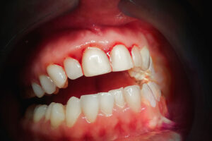 Close-up of a patient’s open mouth showing red, inflamed, and bleeding gums—a clear sign of gum disease or gingivitis affecting the upper front teeth.
